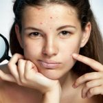 10 most effective acne remedies