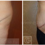 Abdominoplasty before and after, surgeon Svetlana Gagarina