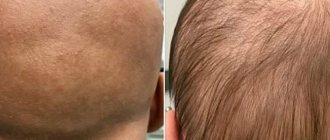 Alopecia in men photo