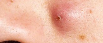 Large subcutaneous pimples