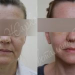 photos before and after facelift