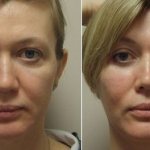 Фото лица до и после применения геля Стилаж