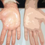Hyperhidrosis - How to get rid of wet palms and feet?