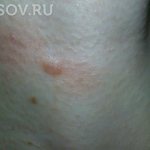A hypertrophic scar developed a month after mole removal