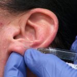 Correction of earlobes with fillers