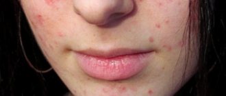 Red acne on the face: causes and treatment