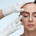 Laser resurfacing of the area around the eyes
