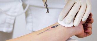 Laser tattoo removal. Reviews, before and after photos 
