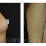 Breast lipofilling before and after photos