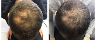 mesotherapy for hair loss