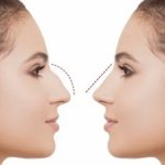 modeling of the nose before rhinoplasty, modeling before rhinoplasty, modeling of nose surgery, rhinoplasty computer modeling, rhinoplasty modeling, rhinoplasty modeling online for free, rhinoplasty online modeling