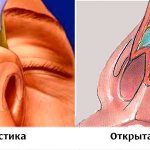 Plastic surgery of the tip of the nose - open and closed access