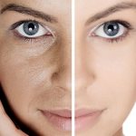 Why are pores enlarged?