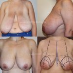 indications for breast reduction