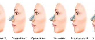 indications for rhinoplasty based on nose type