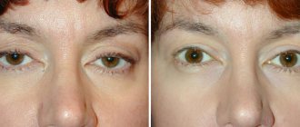 Drooping eyelids after Botox: reasons, how to fix them, advice from cosmetologists