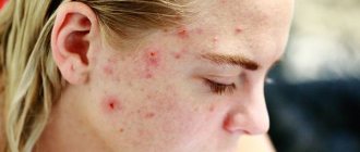 Causes of pimples (blackheads) on the face