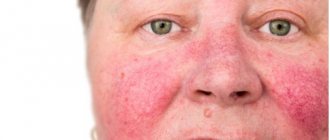 Signs of aging and other aesthetic defects - rosacea