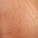stretch marks on the skin in men