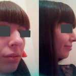 Rhinoplasty - before and after photos. Operated by Usachev I.A. 