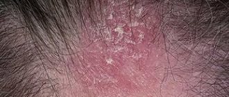 Seborrheic dermatitis of the scalp