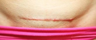 Suture after surgery
