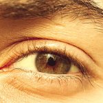 Склер глаз и желтушность кожи после запоя - Веримед