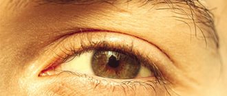 Склер глаз и желтушность кожи после запоя - Веримед