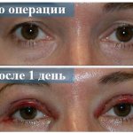 How long does it take to fully recover after blepharoplasty?