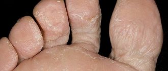 skin peeling off toes