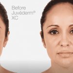 Comparison of fillers for contouring
