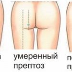 Degrees of ptosis of the buttocks