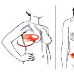 TRAM flap breast reconstruction technology