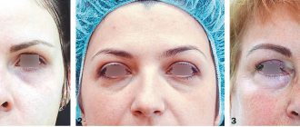 Three types of changes in the lower eyelid area