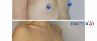 Breast augmentation: before and after photos (primary rehabilitation)