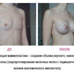 Увеличение груди Рязань
