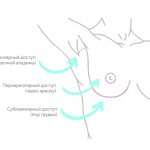 Types of access for breast augmentation.jpg