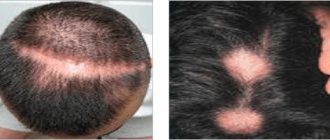Types and types of alopecia