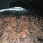 Congenital hypertrichosis on the back
